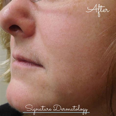 Marionette Lines Before and After | Signature Dermatology