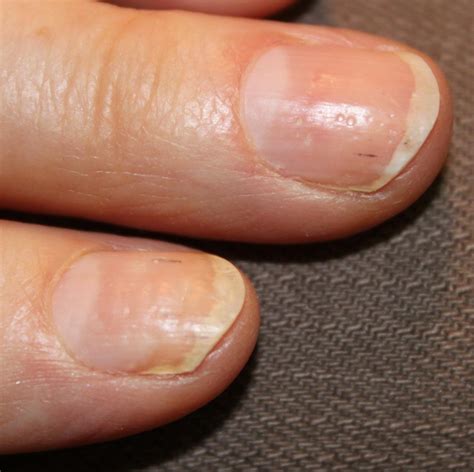 Current Concepts In Treating Psoriatic Nails