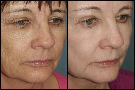 Deep Chemical Peel Birmingham, AL | Best Chemical Peels in Montgomery