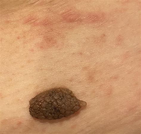 I’be had this mole (literally) my whole life. Just recently I’ve developed a rash around it and ...