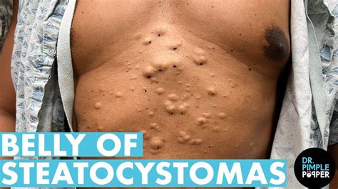 A Belly Full Of Steatocystomas! Dr Pimple Popper Mines a Patient's ...