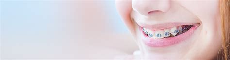 Pros and Cons of Braces | Braces Cost in Pune | Dental Sphere