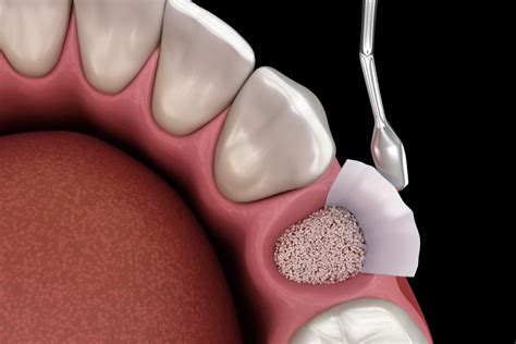 Bone Grafting | San Diego | Welcome to West Coast Oral Surgery