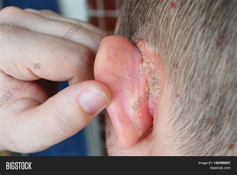 Psoriasis Behind Ear, Image & Photo (Free Trial) | Bigstock