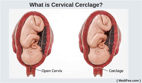 Cervical Cerclage Surgery: Methods, Procedures and Risks