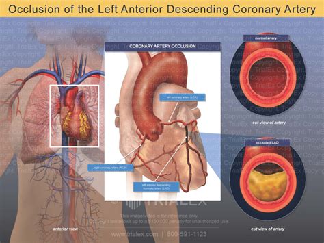 Occlusion of the Left Anterior Descending Coronary Artery - Trial...