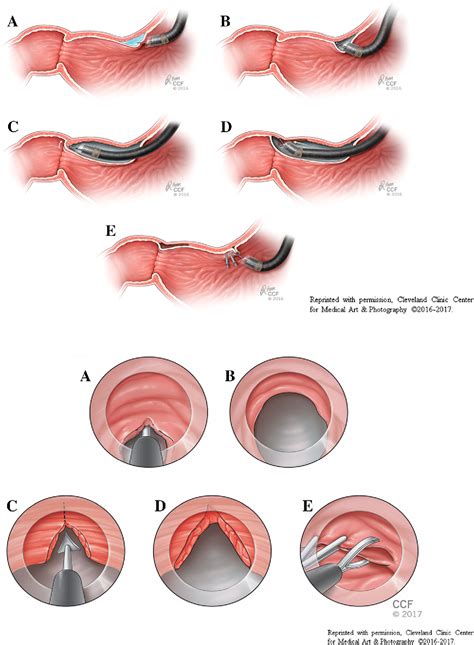 Per oral endoscopic pyloromyotomy for refractory gastroparesis: initial ...