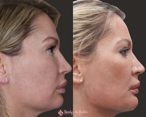 Jawline Fillers Before After Results At Skinly