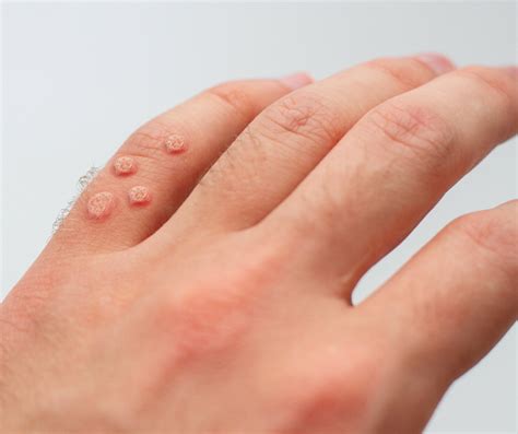 Wart Treatment — Freyja Medical