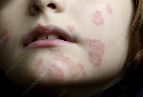 Food Allergy Rash On Face : Allergy Rash - Hives Food Allergy and Hives Skin Allergy ... - An ...