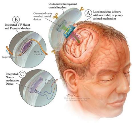 Hydrocephalus Shunt