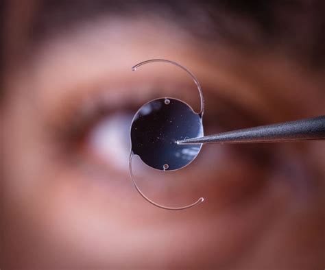 How Much Does ICL Eye Surgery Cost? | Planet Lasik