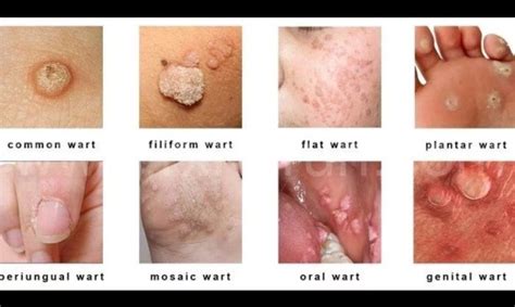 Warts; Causes, Symptoms, Diagnosis, Treatment - Rxharun