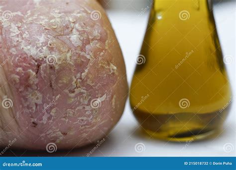 Severe Pustular Psoriasis Lesions on the Heel Stock Photo - Image of ...