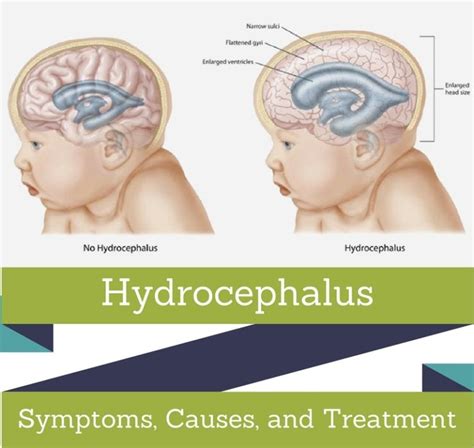 Hydrocephalus : Symptoms, Picture, Causes, And Treatment