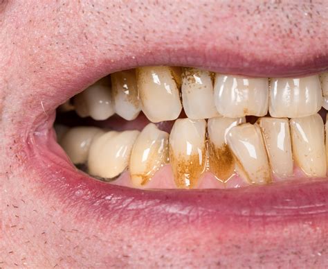 Tea Stains On Teeth