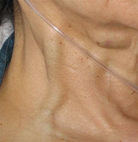 List 94+ Pictures Where Is The Jugular Vein Located In The Body Superb