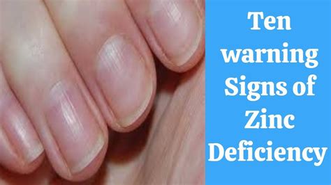 warning Signs of Zinc Deficiency and How to Treat It - YouTube