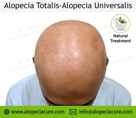 Alopecia Universalis