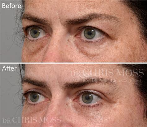 Upper Blepharoplasty Before After