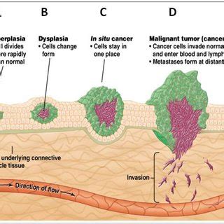 Stages of tumor development and mechanism of metastasis | Download Scientific Diagram