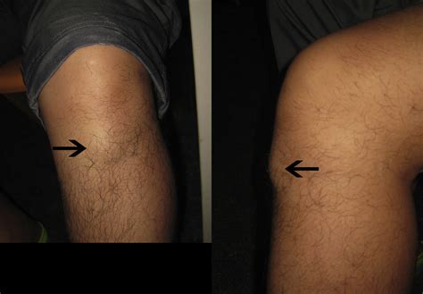 Endoscopic Resection of Gouty Tophus of the Patellar Tendon - Arthroscopy Techniques