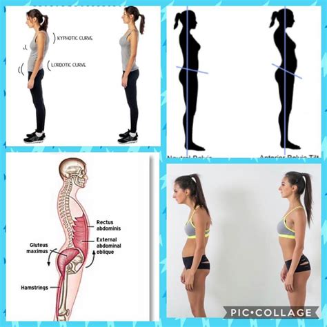 Poor posture, and the anterior pelvic tilt – Nagy Orthodontic Academy – Orthodontic Continuing ...