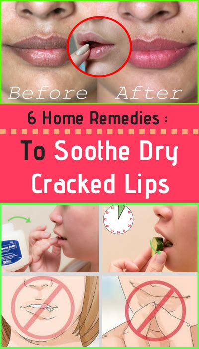 Here Are 6 Home Remedies To Soothe Dry Cracked Lips – Healthy National | Dry cracked lips ...