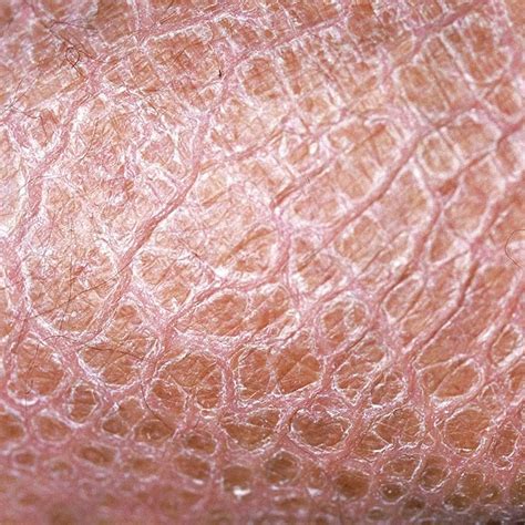 Ichthyosis - Zeroderma