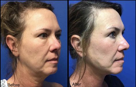 Woman with Face & Neck Lift - Before and After - Carolina Coastal Plastic Surgery