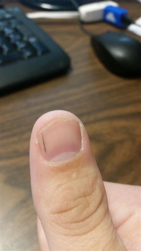 Black Lines On Fingernails Mean