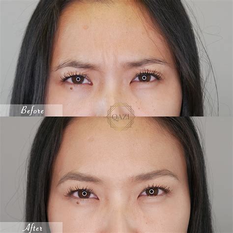 Best Botox in Orange County, CA | Qazi Cosmetic Center