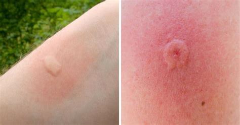 Here Are 8 Common Bug Bites And How You Can Recognize Them