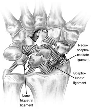 Pin on Wrist Pain