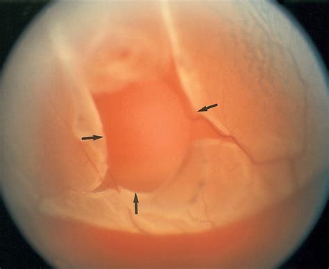 👉 Detached Retina - Pictures, Recovery time, Symptoms, Treatment ...