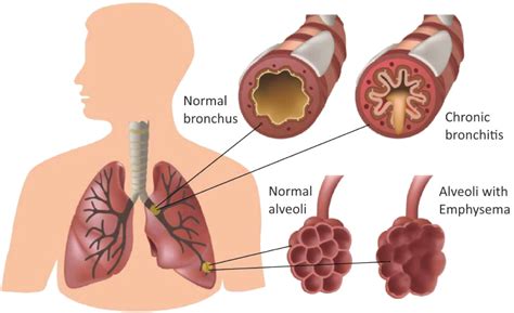 copd - DrBeckmann