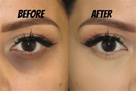 13 natural ways to treat dark circles under the eyes at home – Artofit