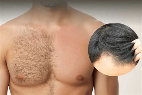 Body Hair Transplant in Turkey | AEK Hair Clinic