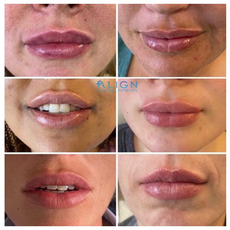 How Long Does Lip Injections Last? - GA Fashion