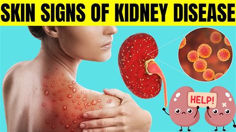 Skin signs of Kidney Disease | Chronic Kidney Disease | Kidney Failure Symptoms - YouTube