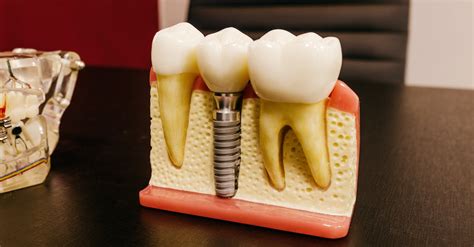 Dental implants with screw on table in clinic · Free Stock Photo