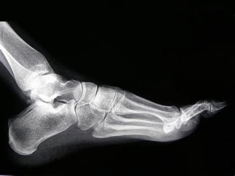 Royalty Free Xray Of Broken Ankle In A Plaster Cast Pictures, Images and Stock Photos - iStock