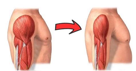 Causes of muscle weakness - Healthy Life