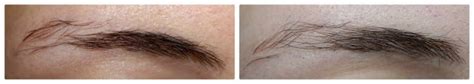 Why itchy eyebrows: causes and treatment (solved) - 2022