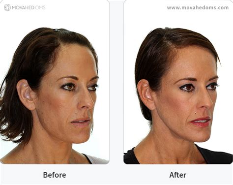 Asymmetrical Face Surgery Before And After