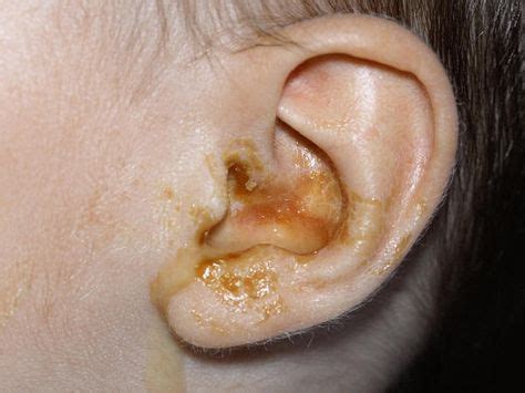 Childhood rashes, skin conditions and infections: photos | Ear ...