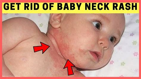 Rash On Face Neck And Chest Toddler - Printable Templates Protal