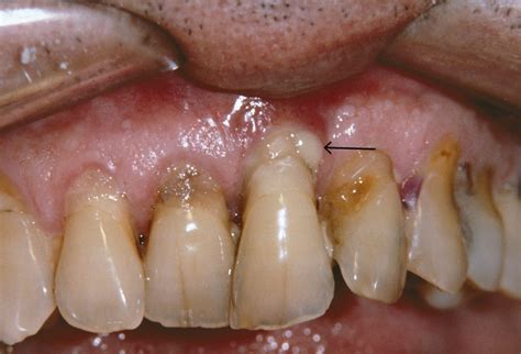 Pyorrhea Is Gum Disease We All Should Know About - Destination Dental Care