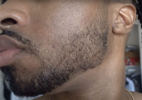 Minoxidil Beard Growth: Before & After, Usage, Side Effects