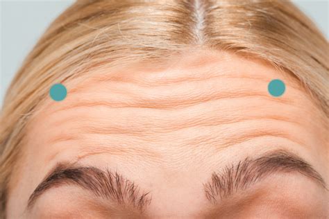 The Easy Fix On How To Correct Spock Eyebrows After Botox